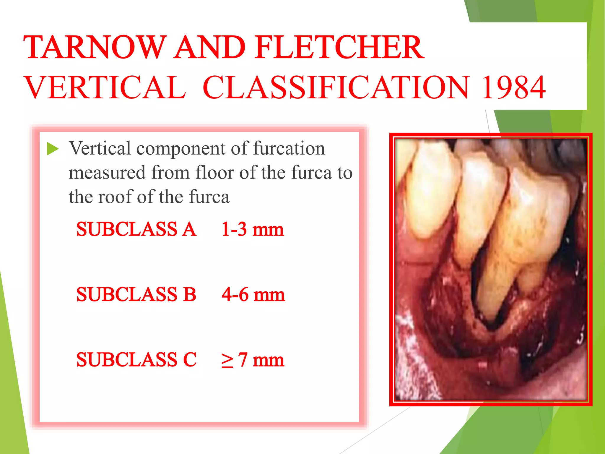 VERTICAL CLASSIFICATION 1984
 Vertical component of furcation
measured from floor of the furca to
the roof of the furca
 