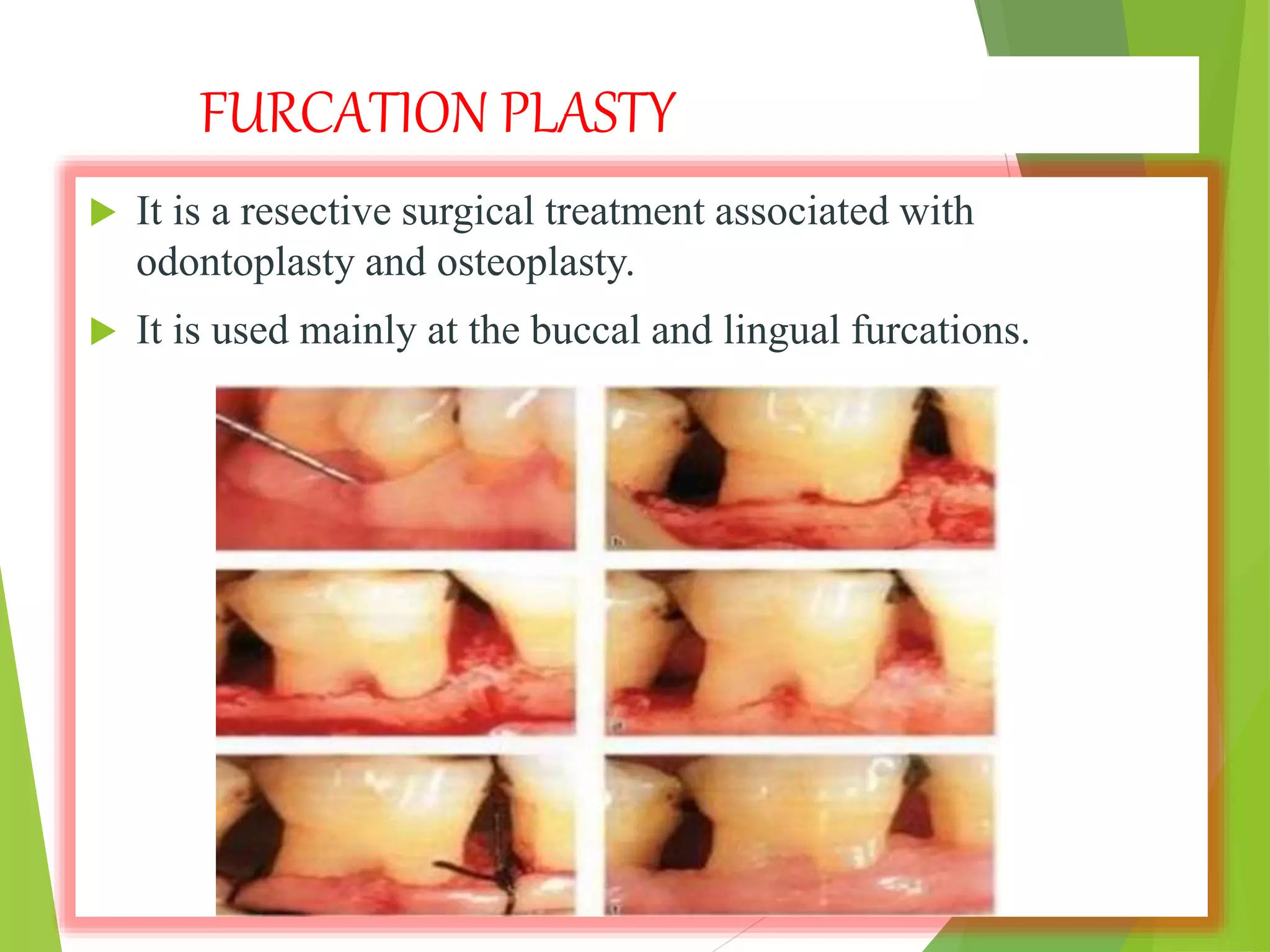FURCATION PLASTY
 It is a resective surgical treatment associated with
odontoplasty and osteoplasty.
 It is used mainly at the buccal and lingual furcations.
 