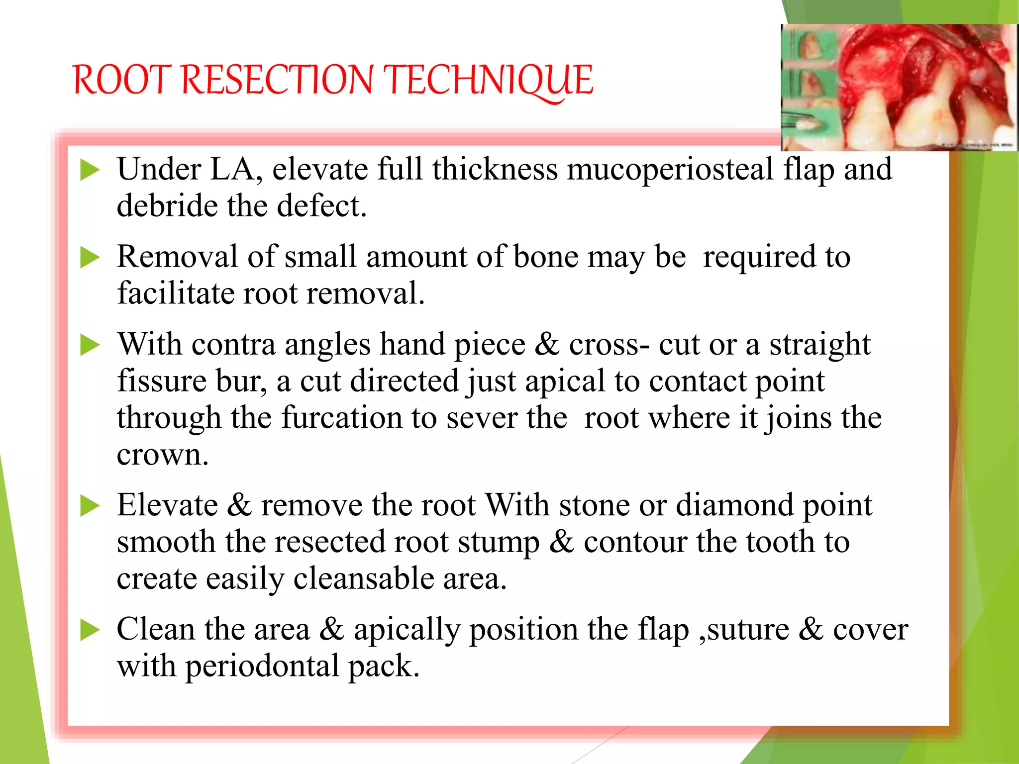 ROOT RESECTION TECHNIQUE
 Under LA, elevate full thickness mucoperiosteal flap and
debride the defect.
 Removal of small amount of bone may be required to
facilitate root removal.
 With contra angles hand piece & cross- cut or a straight
fissure bur, a cut directed just apical to contact point
through the furcation to sever the root where it joins the
crown.
 Elevate & remove the root With stone or diamond point
smooth the resected root stump & contour the tooth to
create easily cleansable area.
 Clean the area & apically position the flap ,suture & cover
with periodontal pack.
 