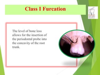 Class I Furcation
The level of bone loss
allows for the insertion of
the periodontal probe into
the concavity of the root
trunk.
 