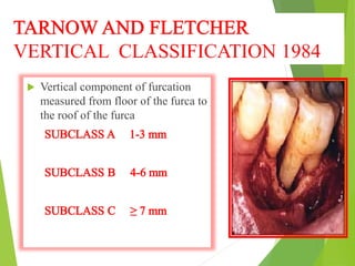 VERTICAL CLASSIFICATION 1984
 Vertical component of furcation
measured from floor of the furca to
the roof of the furca
 