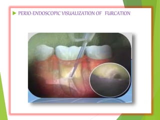  PERIO-ENDOSCOPIC VISUALIZATION OF FURCATION
 