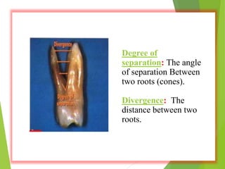 Degree of
separation: The angle
of separation Between
two roots (cones).
Divergence: The
distance between two
roots.
 