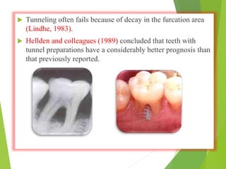  Tunneling often fails because of decay in the furcation area
(Lindhe, 1983).
 Hellden and colleagues (1989) concluded that teeth with
tunnel preparations have a considerably better prognosis than
that previously reported.
 