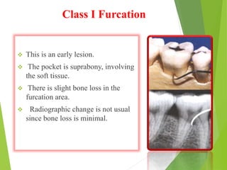 Class I Furcation
 This is an early lesion.
 The pocket is suprabony, involving
the soft tissue.
 There is slight bone loss in the
furcation area.
 Radiographic change is not usual
since bone loss is minimal.
 