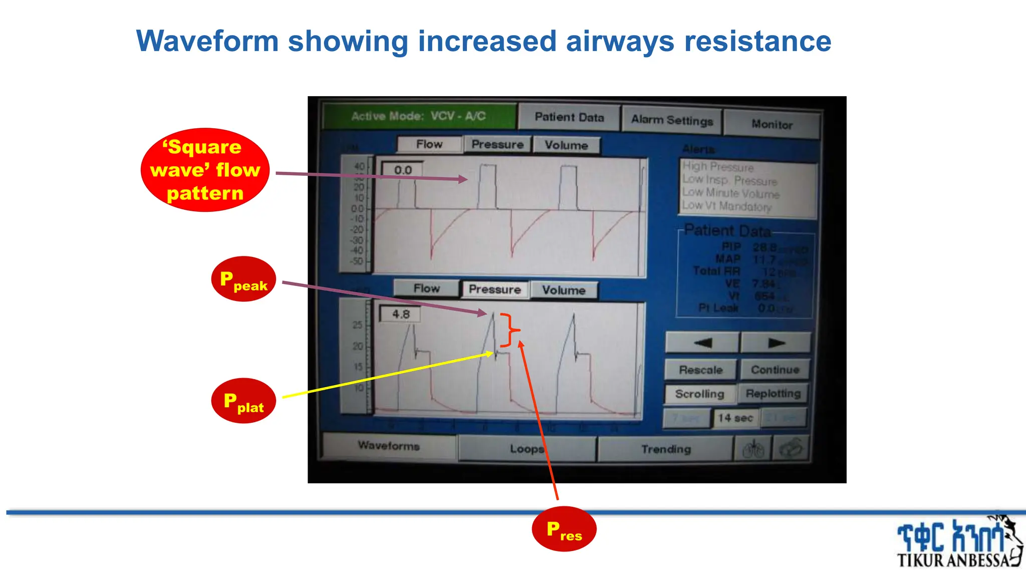 Waveform showing increased airways resistance
Ppeak
Pplat
Pres
‘Square
wave’ flow
pattern
 