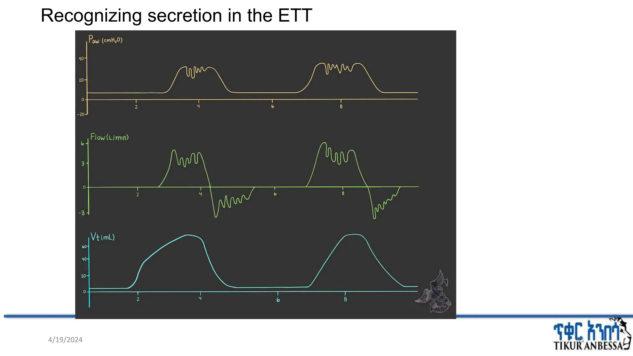 Recognizing secretion in the ETT
51
4/19/2024
 