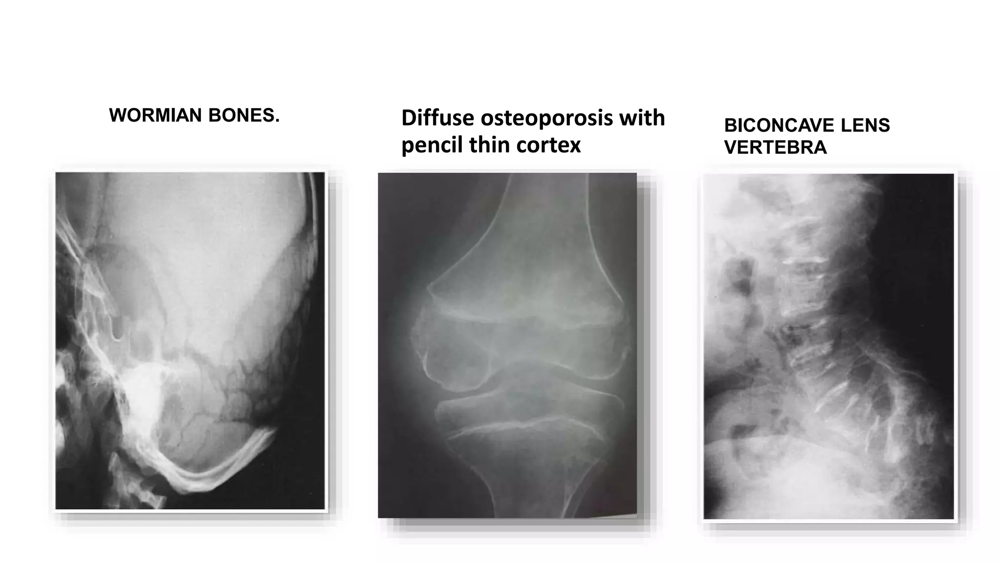skeletal dysplasia ppt | PPTX