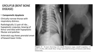 skeletal dysplasia ppt | PPTX