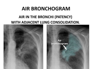 chest x ray alveolar diseases.pptx