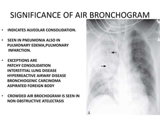 chest x ray alveolar diseases.pptx
