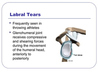 Labral Tears
 Frequently seen in
throwing athletes
 Glenohumeral joint
receives compressive
and shearing forces
during the movement
of the humeral head,
anteriorly to
posteriorly
 