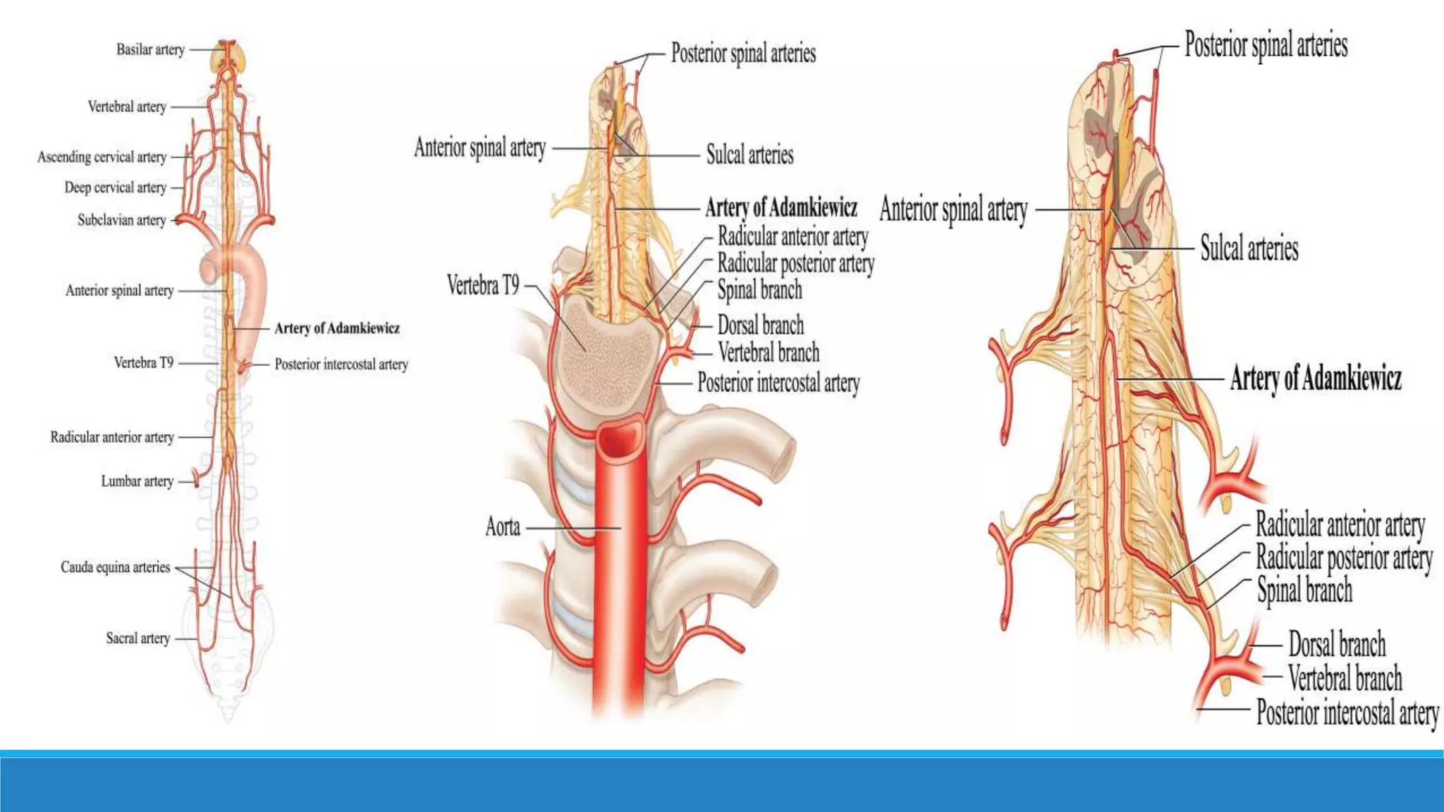 spinal angiography with spnal av anomalies | PPTX