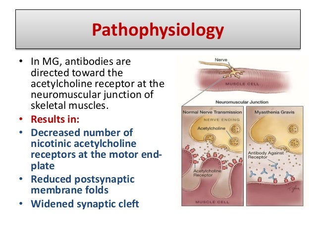 Myasthenia Gravis with Thymoma