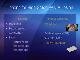 Options for High Grade PASTA Lesion 
Traditional 
• Debridement 
• Decompression / 
Acromioplasty 
• Repair 
– 
– Trans-osseous repair 
– Trans-tendon repair 
Advanced Technology 
• PASTA Bridge 
• Platelet-rich plasma (PRP) 
• Stem cells (BMAC) 
• FlexiGraft DBM sponge 
 