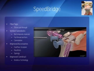SpeedBridge 
• FiberTape 
– Tissue pull through 
• Vented Swivelocks 
– BioComposite material 
– Full thread anchors 
– Cannulation 
• Improved Accessories 
– FastPass Scorpion 
– PassPorts 
– Synergy 
• Improved Construct 
– Knotless Technology 
 