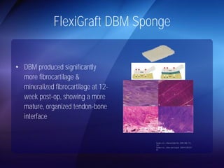 FlexiGraft DBM Sponge 
• DBM produced significantly 
more fibrocartilage & 
mineralized fibrocartilage at 12- 
week post-op, showing a more 
mature, organized tendon-bone 
interface 
Sundar et al., J Biomed Mater Res. 2009; 88B: 115- 
122 
Sundar et al., J Bone Joint Surg Br. 2009;91;(9)1257- 
62 
 