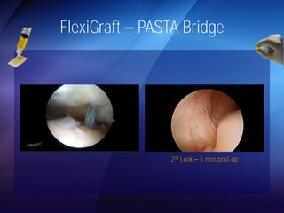 FlexiGraft PASTA Bridge 
2nd Look 5 mos post-op 
 