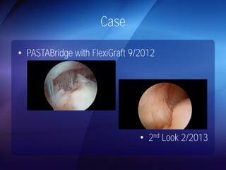 Case 
• PASTABridge with FlexiGraft 9/2012 
• 2nd Look 2/2013 
 