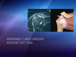 REPAIRABLE LARGE-MASSIVE 
ROTATOR CUFF TEAR 
 