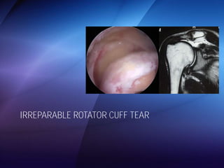 IRREPARABLE ROTATOR CUFF TEAR 
 