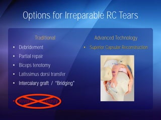 Options for Irreparable RC Tears 
Traditional 
• Debridement 
• Partial repair 
• Biceps tenotomy 
• Latissimus dorsi transfer 
• 
• Reverse arthroplasty 
Advanced Technology 
• Superior Capsular Reconstruction 
 