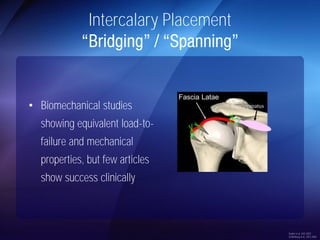 Intercalary Placement 
• Biomechanical studies 
showing equivalent load-to-failure 
and mechanical 
properties, but few articles 
show success clinically 
Snyder et al, IJSS 2007 
Schlamberg et al, JSES 2004 
 