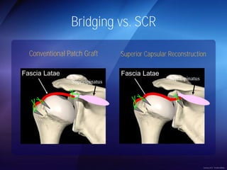 Bridging vs. SCR 
Conventional Patch Graft Superior Capsular Reconstruction 
Courtesy of Dr. Teruhisa Mihata 
 