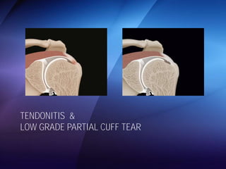TENDONITIS & 
LOW GRADE PARTIAL CUFF TEAR 
 