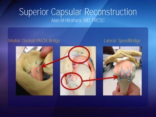 Superior Capsular Reconstruction 
Alan M Hirahara, MD, FRCSC 
Medial: Glenoid PASTA Bridge Lateral: SpeedBridge 
 