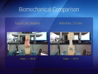 Biomechanical Comparison 
Fascia Lata, Doubled ArthroFlex, 3.5 mm 
Failure = 180 N Failure = 550 N 
 