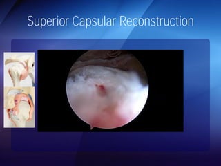 Superior Capsular Reconstruction 
 