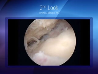 2nd Look 
Terahisu Mihata, MD 
 