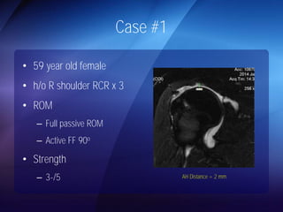 Case #1 
• 59 year old female 
• h/o R shoulder RCR x 3 
• ROM 
– Full passive ROM 
– Active FF 90o 
• Strength 
– 3-/5 AH Distance = 2 mm 
 