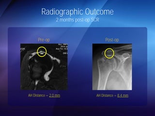 Radiographic Outcome 
2 months post-op SCR 
Pre-op Post-op 
AH Distance = 2.0 mm AH Distance = 8.4 mm 
 