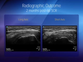 Radiographic Outcome 
2 months post-op SCR 
Long Axis Short Axis 
 