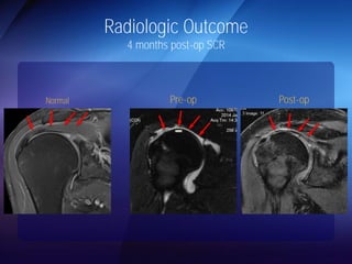 Radiologic Outcome 
4 months post-op SCR 
Normal Pre-op Post-op 
 