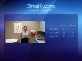 Clinical Outcome 
3 months post-op SCR 
Pre-op Post-op 
• VAS Scores: 5  1 
• ASES Scores: 58  82 
• Forward flex: 90  160 
 