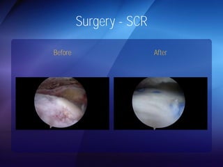 Surgery - SCR 
Before After 
 