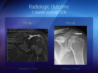 Radiologic Outcome 
1 month post-op SCR 
Pre-op Post-op 
AH Distance = 3.5 mm AH Distance = 9.6 mm 
 