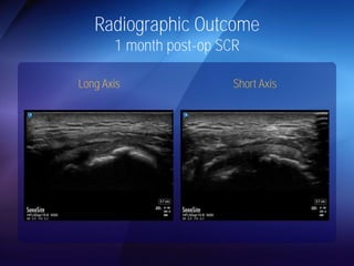 Radiographic Outcome 
1 month post-op SCR 
Long Axis Short Axis 
 