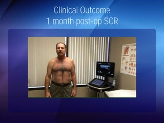 Clinical Outcome 
1 month post-op SCR 
 