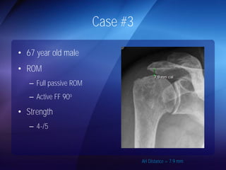 Case #3 
AH Distance = 7.9 mm 
• 67 year old male 
• ROM 
– Full passive ROM 
– Active FF 90o 
• Strength 
– 4-/5 
 