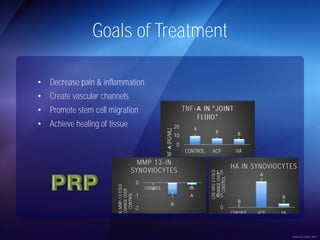 Goals of Treatment 
• Decrease pain & inflammation 
• Create vascular channels 
• Promote stem cell migration 
• Achieve healing of tissue 
B 
A 
B 
1.5 
1 
0.5 
0 
CONTROL ACP HA 
LOG HAS-2 FOLD 
CHANGE OVER 
CONTROL 
HA IN SYNOVIOCYTES 
20 
10 
MMP 13-IN 
SYNOVIOCYTES 
A 
B 
A 
0 
-1 
-2 
CONTROL ACP HA 
LOG MMP-13 FOLD 
CHANGE OVER 
CONTROL 
A 
B B 
0 
CONTROL ACP HA 
TNF-Α (PG/ML) 
TNF- Α 
Fortier et al, AJSM, 2014 
 