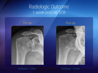 Radiologic Outcome 
1 week post-op SCR 
Pre-op Post-op 
AH Distance = 7.9 mm AH Distance = 8.3 mm 
 