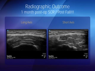 Radiographic Outcome 
1 month post-op SCR / Post Fall!!! 
Long Axis Short Axis 
 
