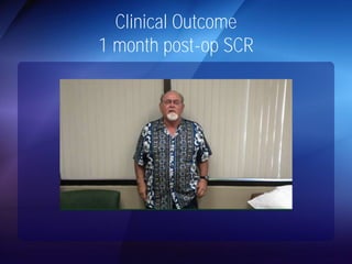 Clinical Outcome 
1 month post-op SCR 
 