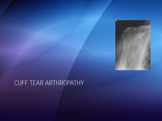 CUFF TEAR ARTHROPATHY 
 