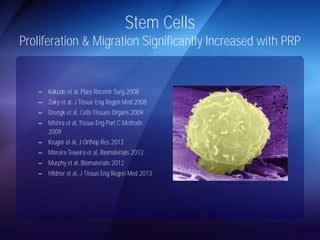 Stem Cells 
Proliferation & Migration Significantly Increased with PRP 
– Kakudo et al, Plast Recontr Surg 2008 
– Zaky et al, J Tissue Eng Regen Med 2008 
– Drengk et al, Cells Tissues Organs 2009 
– Mishra et al, Tissue Eng Part C Methods 
2009 
– Kruger et al, J Orthop Res 2012 
– Moreira Teixeira et al, Biomaterials 2012 
– Murphy et al, Biomaterials 2012 
– Hildner et al, J Tissue Eng Regen Med 2013 
 
