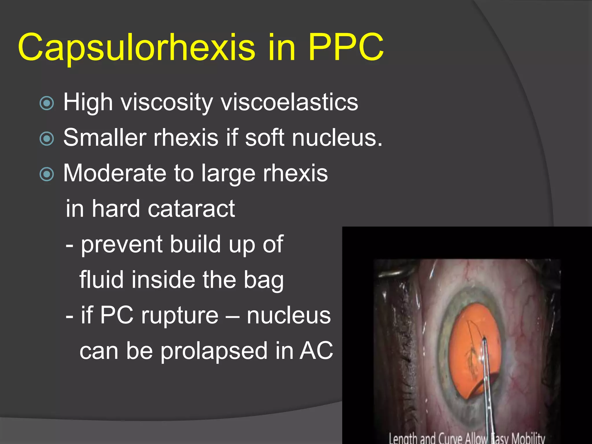 My technique to handle posterior polar cataract | PPTX